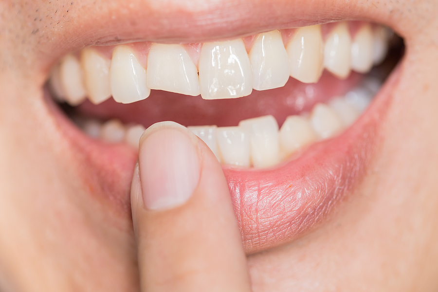 Chipped, Cracked Teeth Restoring in San Pablo CA, Dentist near me, San Pablo CA (510) 262-0611 